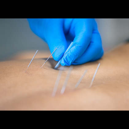 Dry Needling